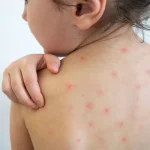 Measles strikes CHT too, 2 children die in Alikadam