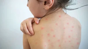 Measles strikes CHT too, 2 children die in Alikadam