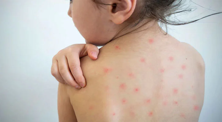 Measles strikes CHT too, 2 children die in Alikadam
